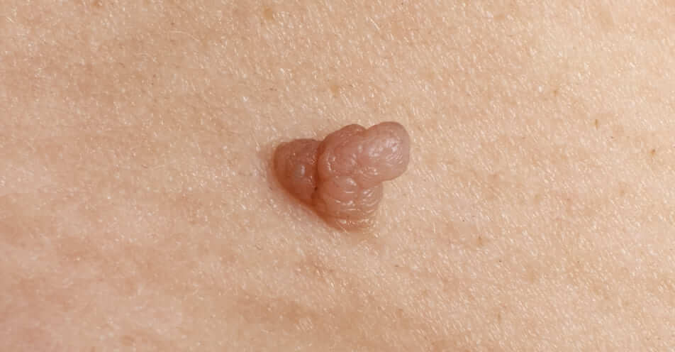 electrofulguracion-urologo-certificado-en-cdmx - Urólogo en CDMX, Dr. Rafael Humberto Sandoval Gómez