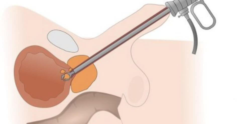 reseccion-transuretral-de-prostata-urologo-certificado-en-cdmx